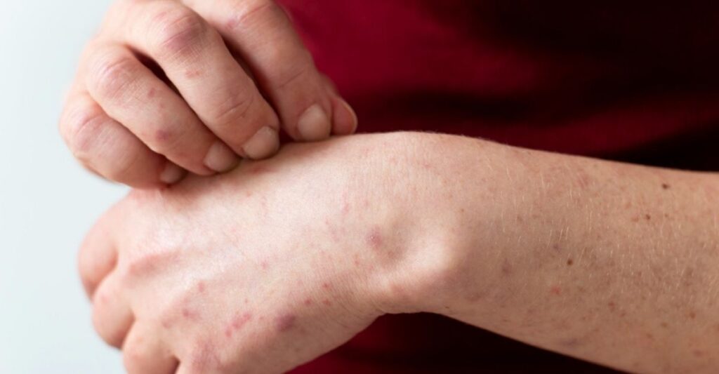 Alerta sanitaria en México: Brote de sarampión suma más de 2,000 casos en 2026